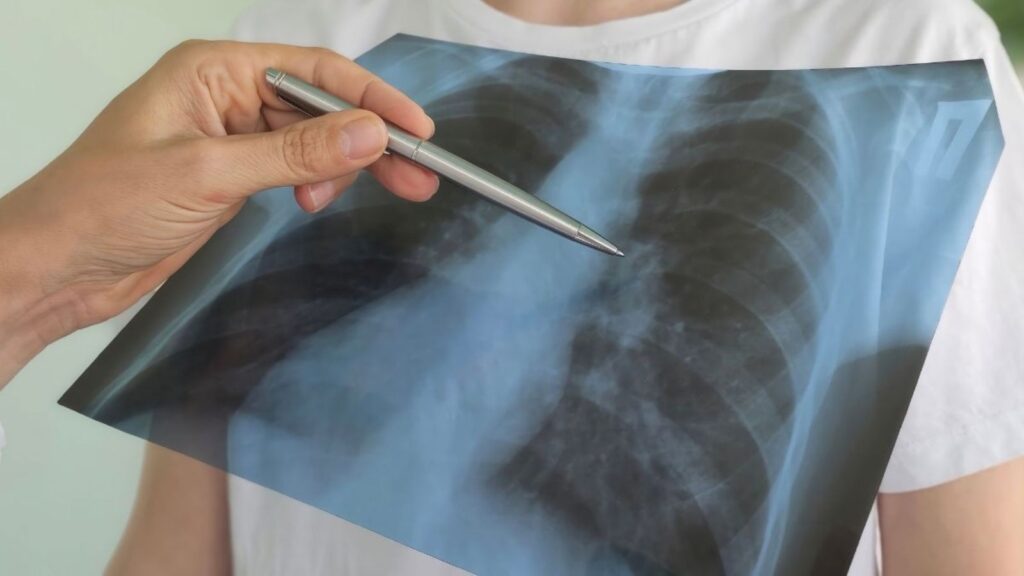 signs of pneumonia